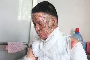 Ăn lẩu, vợ chồng bị bếp cồn đốt cháy ảnh 1