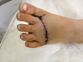 Bé gái gần đứt lìa bàn chân vì miếng chắn pô xe máy ảnh 1