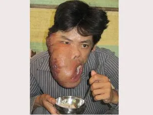 Bị bướu “ăn” nửa mặt ảnh 1