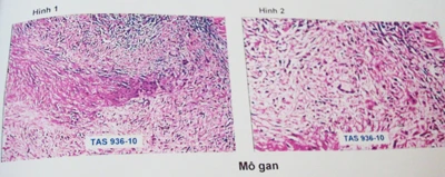 Thoát chết với bệnh lao gan hiếm gặp ảnh 1 Thoát chết với bệnh lao gan hiếm gặp ảnh 1