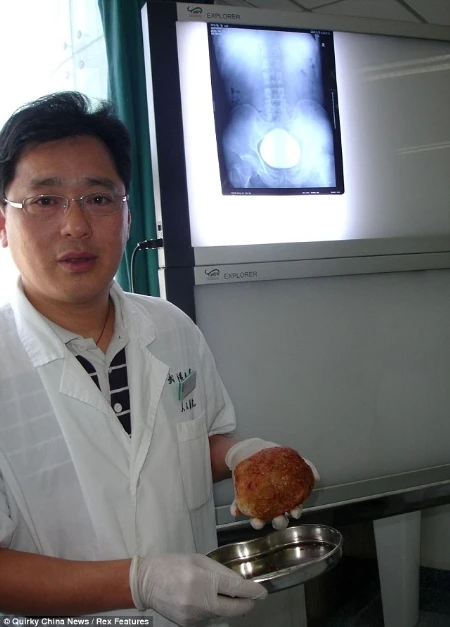 Mổ lấy sỏi bàng quang khổng lồ nặng hơn 1 kg ảnh 2