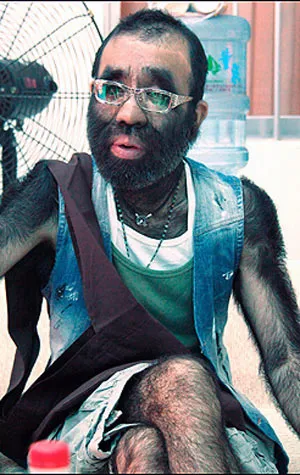 Người đóng Tây Du Ký chuẩn bị phẫu thuật lông ảnh 1 Người đóng Tây Du Ký chuẩn bị phẫu thuật lông ảnh 1