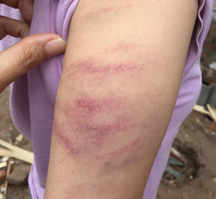 Không làm bài tập, học sinh bị cô giáo đánh tím tay ảnh 1