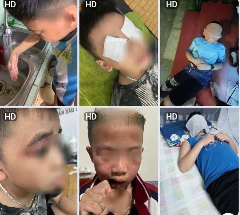 Hình ảnh nhiều học sinh bị dị ứng, sưng mắt sau khi nhà trường phun thuốc muỗi. Ảnh CTV Dị ứng
