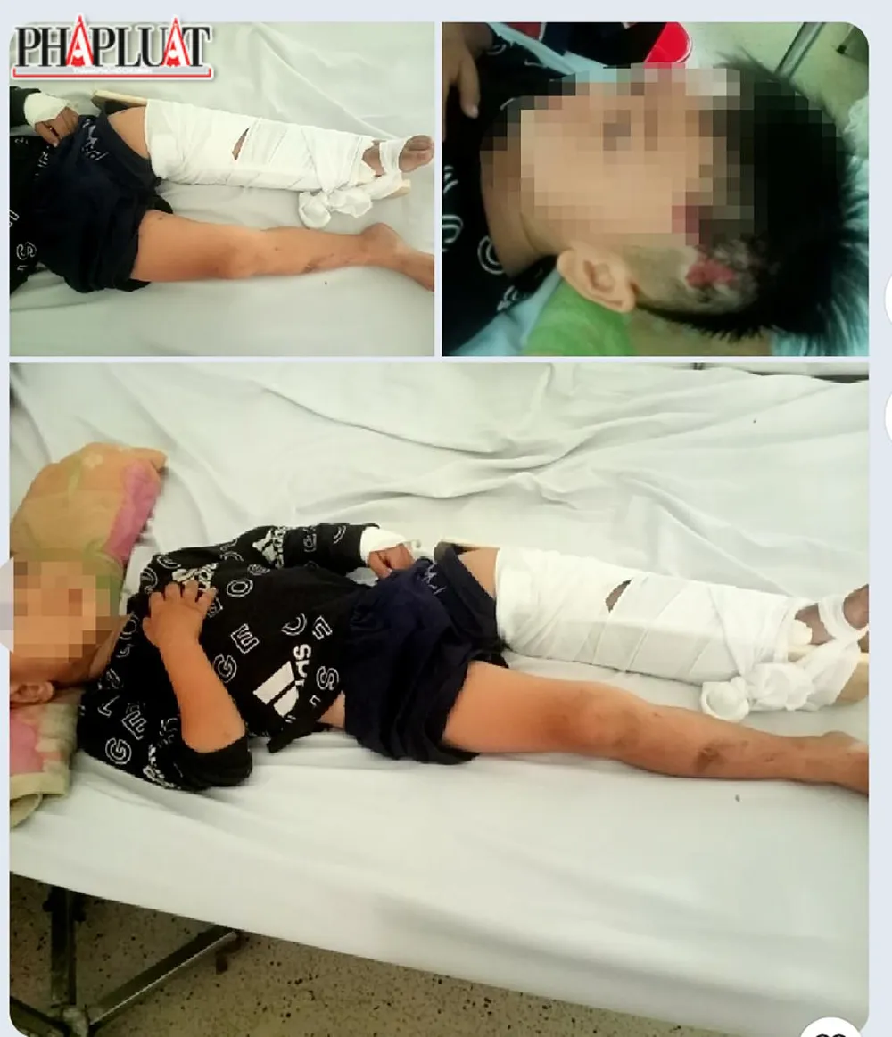 Theo gia đình, bé trai bị gãy chân, đầu xây xát nhưng không ảnh hưởng đến tính mạng. Ảnh: GĐCC Theo gia đình, bé trai bị gãy chân, đầu xây xát nhưng không ảnh hưởng đến tính mạng. Ảnh: GĐCC