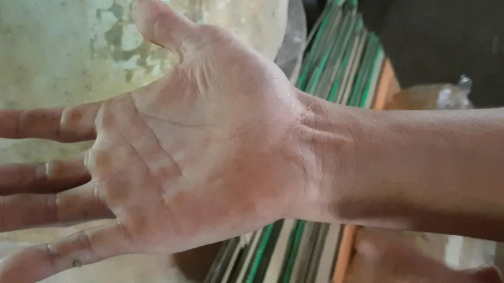 Trong một lần bất cẩn khi cho khỉ ăn, anh Dũng bị khỉ cắn gây ra vết sẹo dài. Ảnh: NT