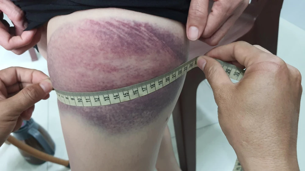 Hai cú đánh tạo ra vết bầm tím dài hàng chục cm trên tay và đùi của chị T. Ảnh: NT