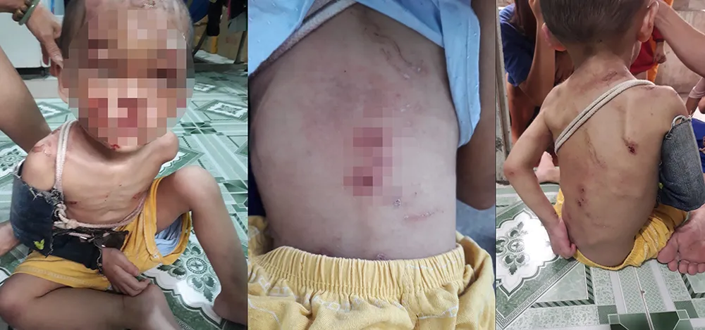 Hình ảnh bé trai bị nhiều vết thương trên người. Ảnh: NDCC Hình ảnh bé trai bị nhiều vết thương trên người. Ảnh: NDCC