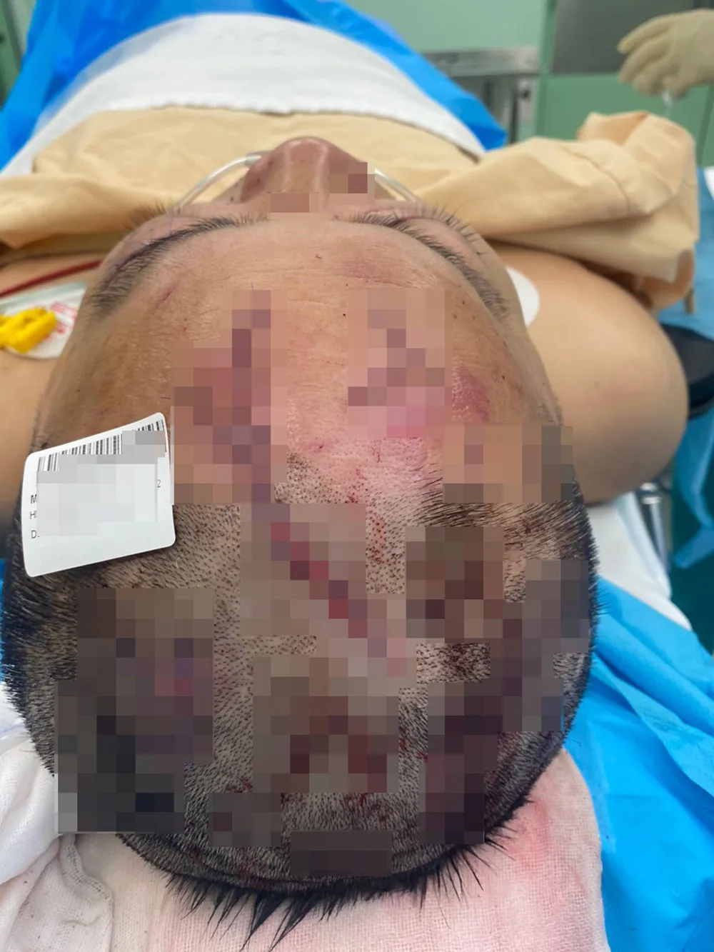 Ông L bị nhiều vết thương trên đầu, lưng và tay sau khoảng 30 giằng co với kẻ trộm. Ảnh: NT mot-giam-doc-dot-nhap-biet-thu-phu-my-hung-danh-chu-nha-de-trom-4.jpg