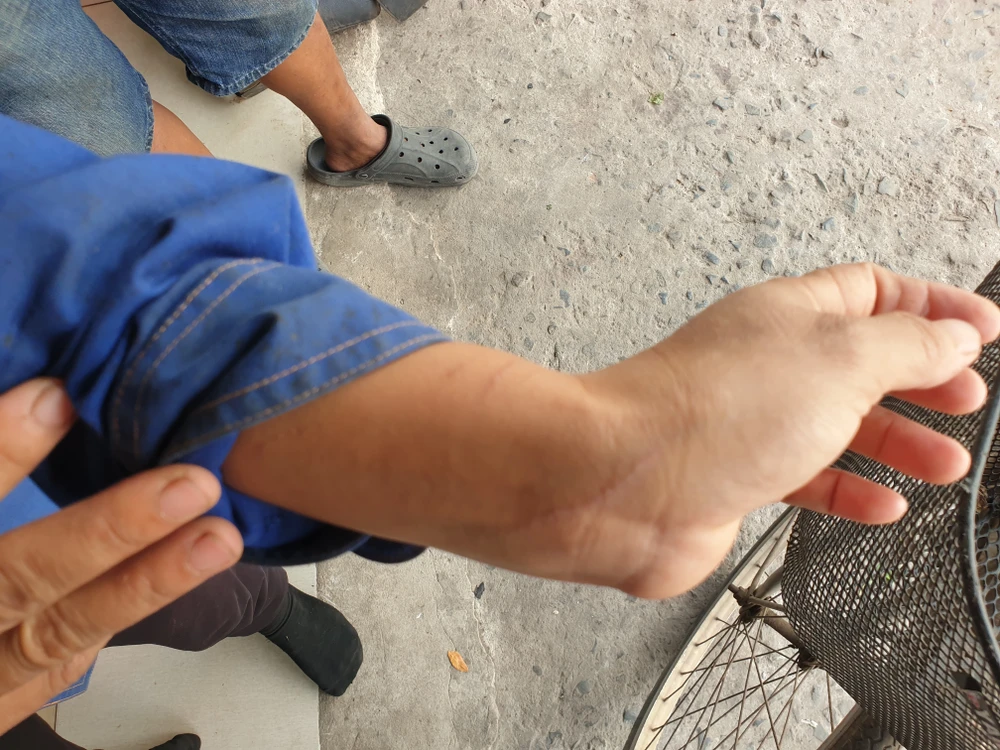 Ngoài ra, vợ của anh Cảnh cũng bị khỉ cào cấu, xước tay. Ảnh: NT Khỉ đực cổ có đeo xích sắt tấn công 4 người ở quận 12