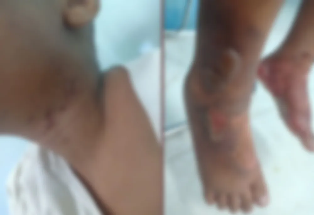 Vụ bé trai bị bỏng ở quận 8: Bắt cha ruột cùng ‘dì ghẻ’