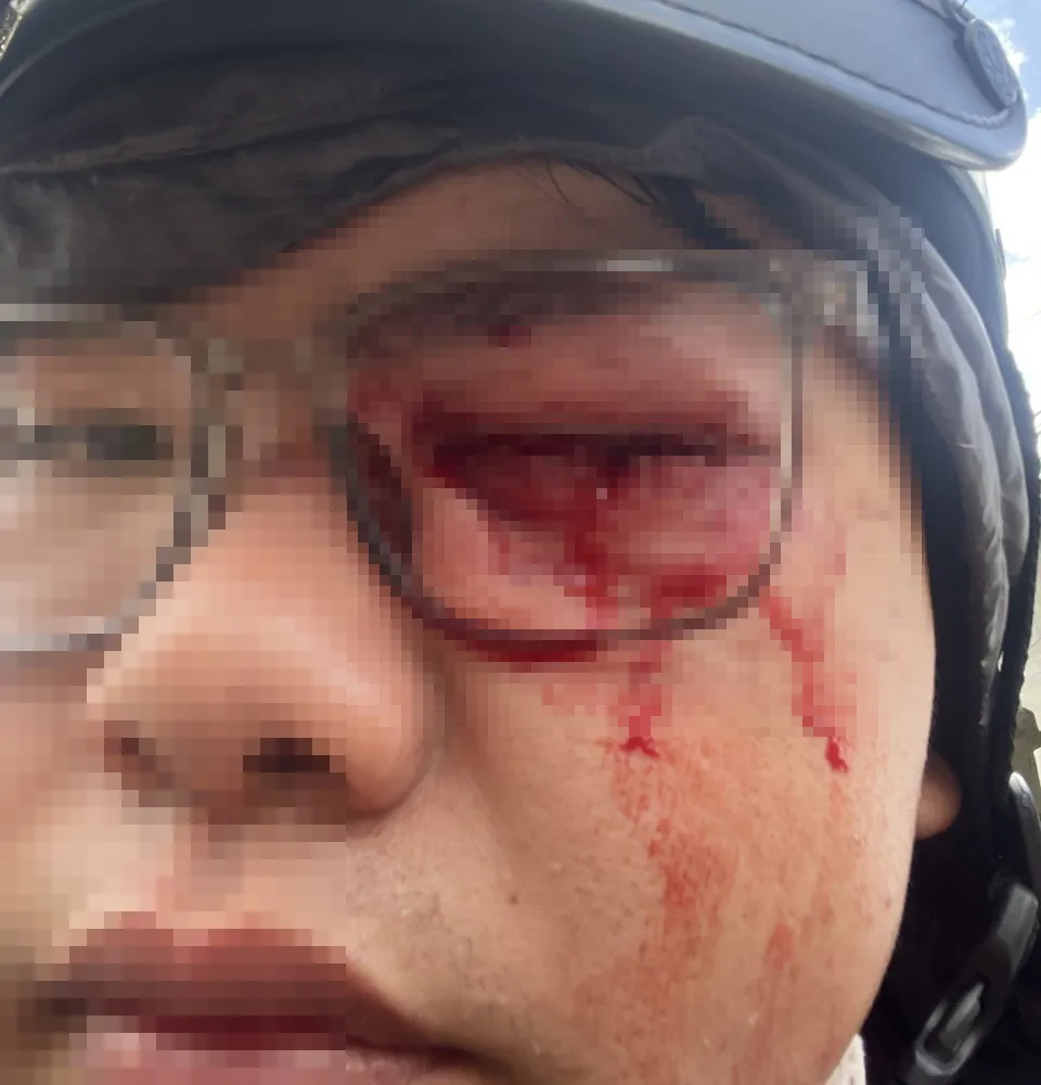 Hình ảnh thương tích anh N. chụp lại sau khi bị "va" phải gậy của CSGT. Ảnh: ĐC Hình ảnh thương tích anh N. chụp lại sau khi bị "va" phải gậy của CSGT. Ảnh: ĐC