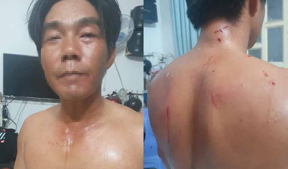 Anh B bị thương nhiều bộ phận sau vụ việc. Ảnh: NY Mùng-1-Tết,-nhóm-chủ-nợ-lao-vào-nhà,-hành-hung-hội-đồng-con-nợ.jpg