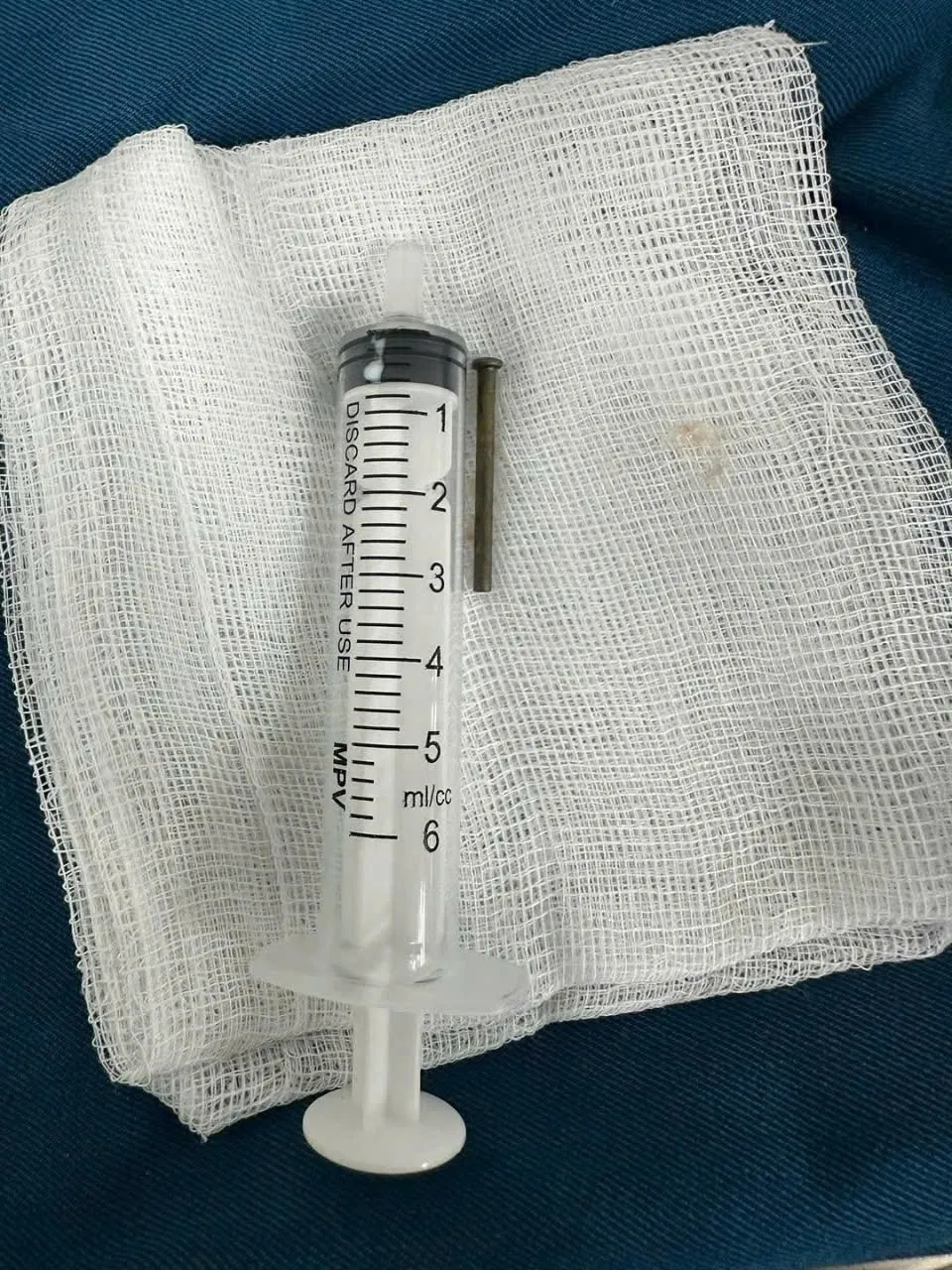 Gắp cây đinh sắt 3cm trong tá tràng bé trai 6 tuổi ở Quảng Ngãi