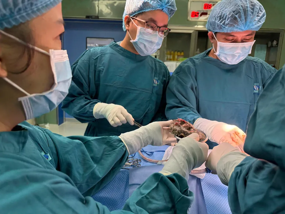 be-gai-an-toc-duoc-phau-thuat-lay-gan-1kg-toc-tu-da-day-ra-ngoai- (3).jpg