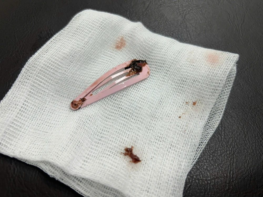 quang-ngai-noi-soi-gap-kep-toc-dai-7cm-khoi-da-day-be-gai-6-tuoi- (2).jpg