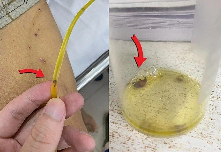 Sán lá gan chui ra từ ống dẫn lưu từ đường mật của nam bệnh nhân hay ăn gỏi cá. Ảnh: Bệnh viện Bạch Mai.