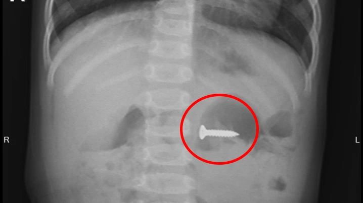 Đinh vít sắc nhọn trong bụng bé gái 2 tuổi