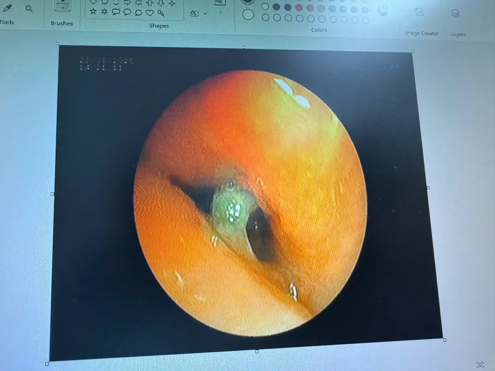 hình ảnh nội soi phế quản.jpg