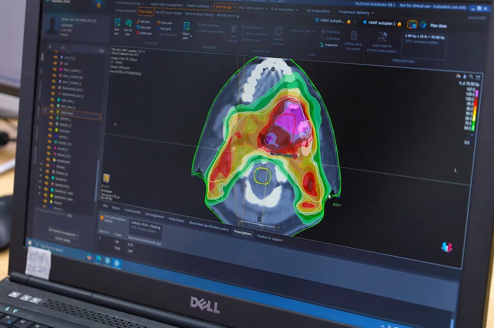 AI xạ trị ung thư: Lập kế hoạch xạ trị nhanh hơn, chính xác hơn