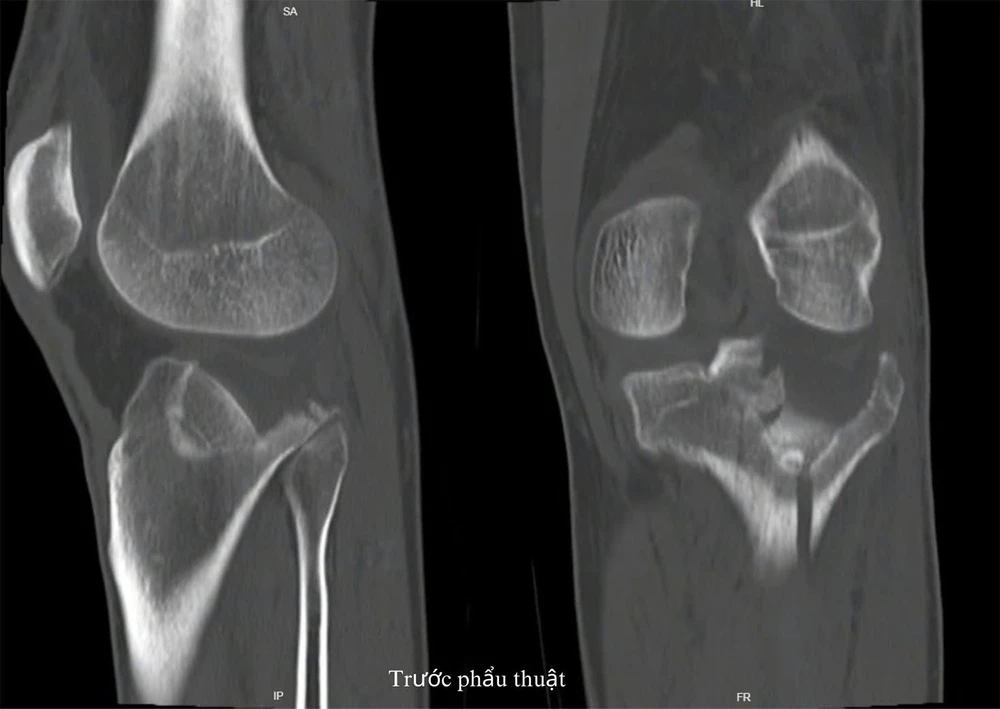 Phẫu thuật thành công ca gãy mâm chày cho bệnh nhân người Nigeria