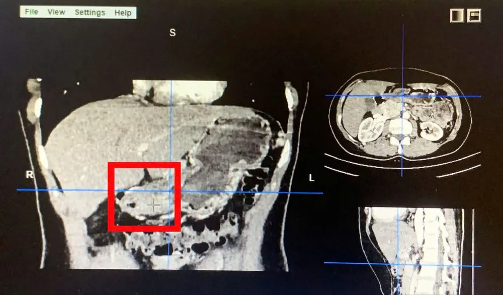 Phẫu thuật nội soi thành công điều trị ung thư dạ dày và nạo vét hạch cho bệnh nhân 43 tuổi