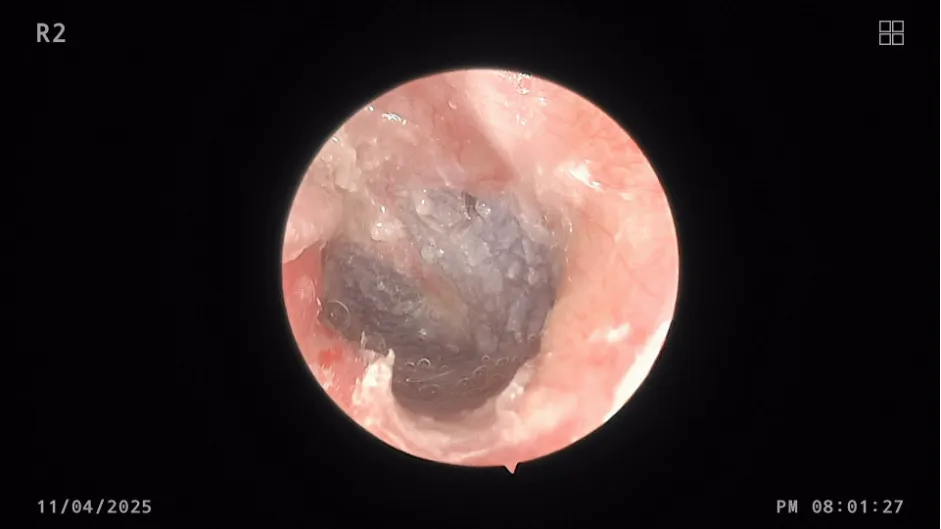 6 tháng sau phẫu thuật: Bệnh nhân nghe tốt, không ù tai, không đau tai, không chít hẹp ống tai. Ảnh: BVCC loi-xuong-ong-taiddđ.png