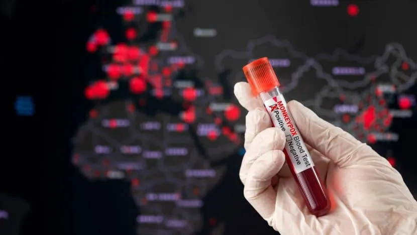 Một mẫu máu có kết quả xét nghiệm dương tính với virus đậu mùa khỉ. Ảnh: ISTOCK