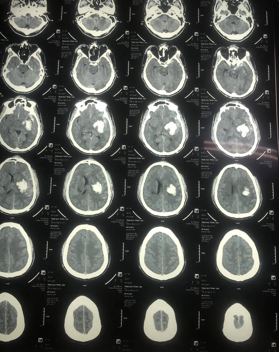 Hình ảnh chụp thương tích xuất huyết bán cầu trái của bệnh nhân Trần Đức Trình