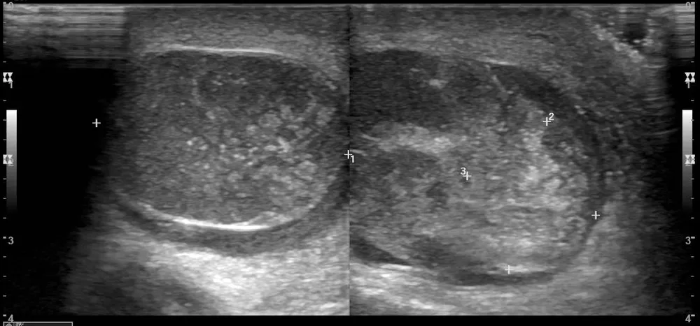 Đến khi đi khám thì tinh hoàn đã bắt đầu có dấu hiệu hoại tử trên siêu âm và xét nghiệm. Ảnh: BSCC