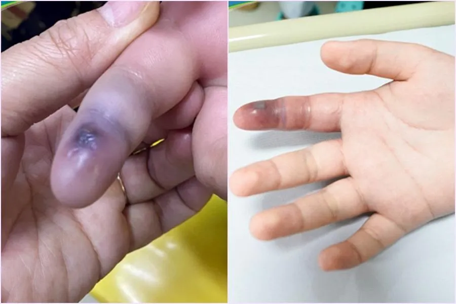 Vết thương do rắn cắn trước và sau một ngày điều trị. Ảnh: BVCC