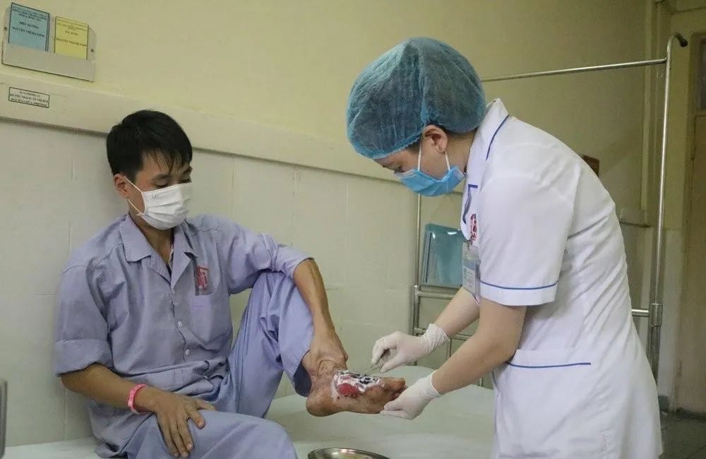 Hoại tử bàn chân do chữa bỏng theo lời thầy lang ảnh 1