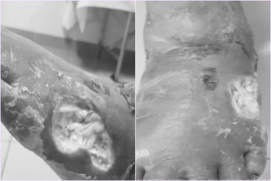 Người bệnh được nhập viện điều trị với chẩn đoán loét hoại tử bàn chân trái. Ảnh: BV