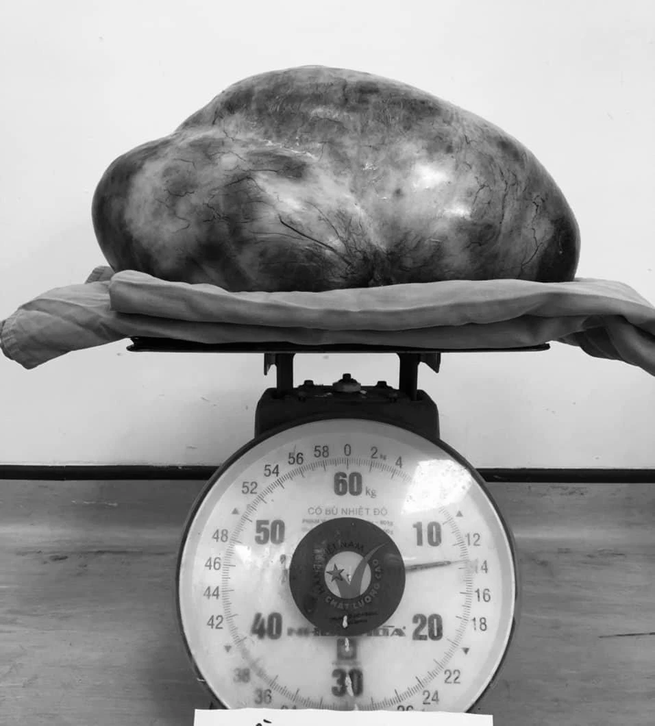 Hình ảnh khối u sau khi được lấy ra từ ổ bụng cô gái. Ảnh: BV