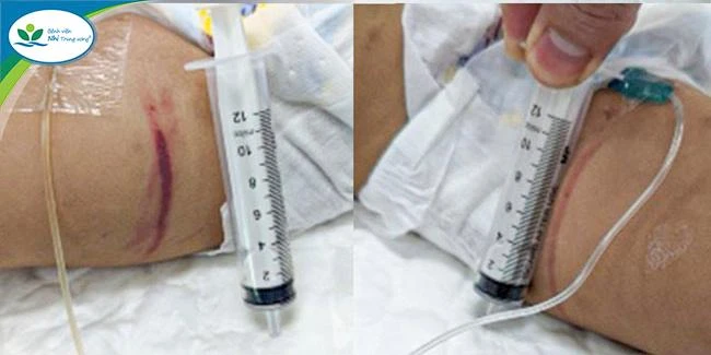 Bé Q.T được đưa đến Bệnh viện Nhi Trung ương với nhiều vết lằn, vết bầm tím tụ máu trên cơ thể. Ảnh: BSCC