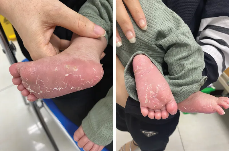 Bé bị bong da tay, da chân ngay sau sinh. Ảnh: BV Bé bị bong da tay, da chân ngay sau sinh. Ảnh: BV