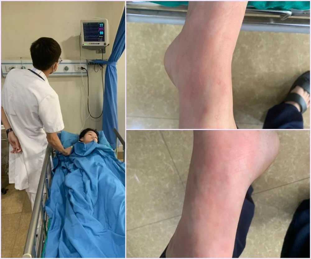 Hình ảnh mẩn ngứa lan rộng toàn thân của bệnh nhi sau khi ăn tôm, cua. Ảnh: BV