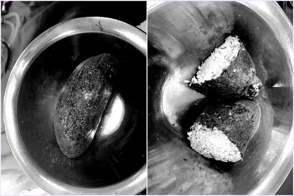 Khối bã thức ăn lớn trong dạ dày bệnh nhân được bác sĩ lấy ra ngoài. Ảnh: BSCC