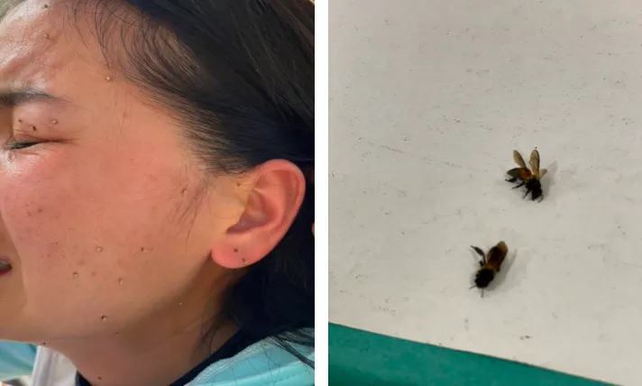 Trong quá trình cấp cứu cho bệnh nhân, nhân viên y tế còn bắt được 3 con ong và nhổ được rất nhiều ngòi ong trên cơ thể người bệnh. Ảnh: BVCC Trong quá trình cấp cứu cho bệnh nhân, nhân viên y tế còn bắt được 3 con ong và nhổ được rất nhiều ngòi ong trên cơ thể người bệnh. Ảnh: BVCC