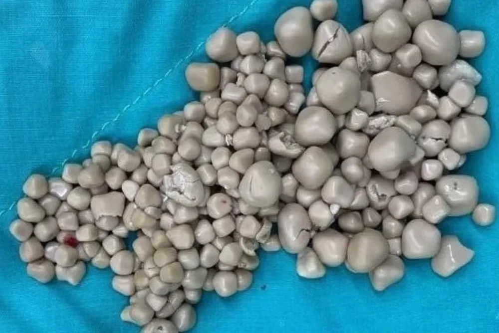 300 viên sỏi thận