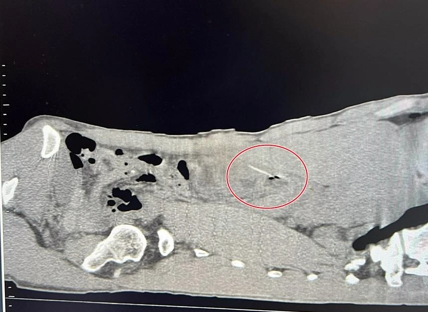 Dị vật tăm tre trong ổ bụng bệnh nhân (vòng đỏ).