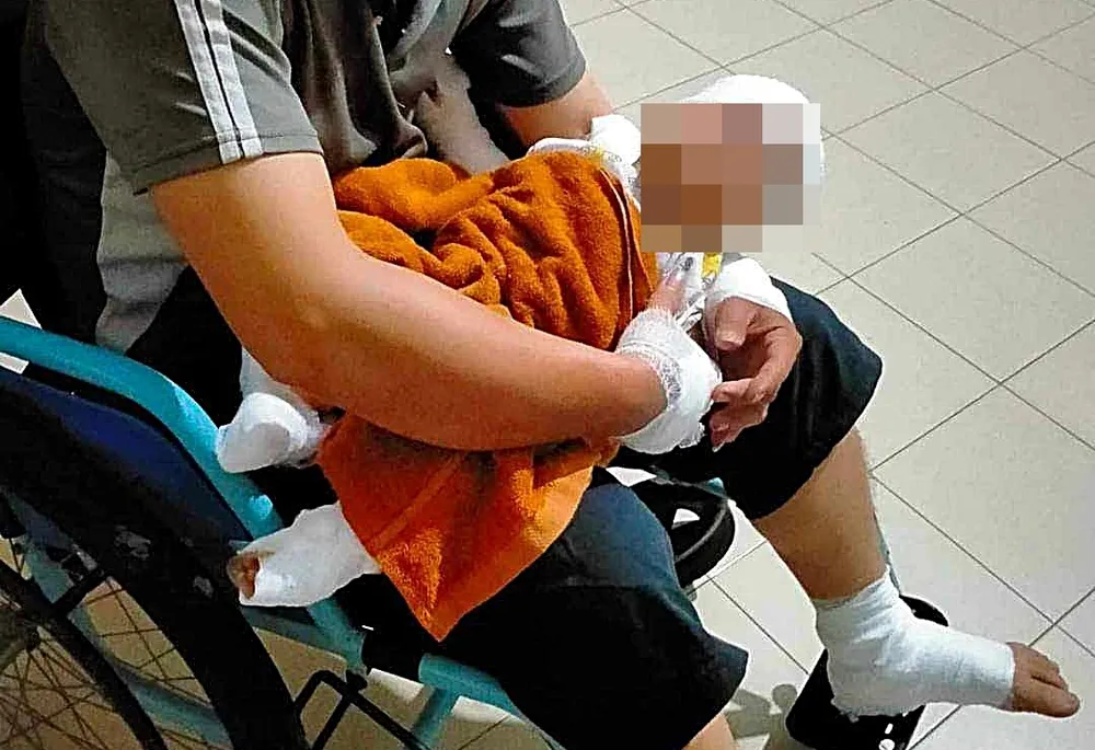 Hai cha con anh VAL đều bỏng nặng do bị ném bom xăng. Ảnh: PP bom-xang1.jpg