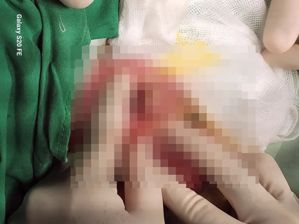 Bệnh nhi bị thủng túi thừa Meckel được phẫu thuật thành công. Ảnh BSN túi thừa