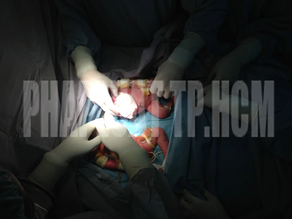 Tách thành công hai bé dính nhau ảnh 2