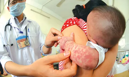 bệnh sởi, Google, vụ chìm phà Hàn Quốc bệnh sởi, Google, vụ chìm phà Hàn Quốc