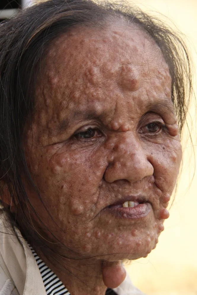 Người phụ nữ với những khối u ảnh 1 Người phụ nữ với những khối u ảnh 1