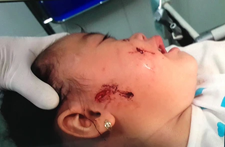 Nhiều trẻ nhập viện vì chó cắn ảnh 1