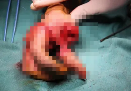 Nối lại thành công hai ngón tay bị cưa máy gỗ cắt đứt ảnh 1