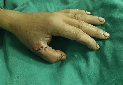 Nối lại thành công hai ngón tay bị cưa máy gỗ cắt đứt ảnh 2