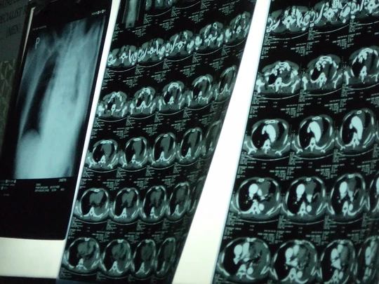  Đoạn 25 cm động mạch chủ ngực bệnh nhân phình to suýt vỡ 